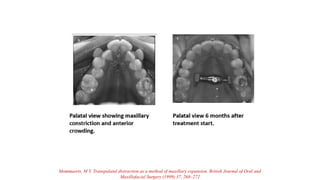 Mommaerts. M Y. Transpalatal distraction as a method of maxillary expansion. British Journal of Oral and
Maxillofacial Surgery (1999) 37, 268–272
 