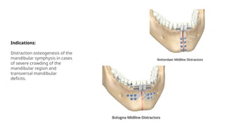 Indications:
Distraction osteogenesis of the
mandibular symphysis in cases
of severe crowding of the
mandibular region and
transversal mandibular
deficits.
 