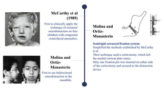 McCarthy et al
(1989)
First to clinically apply the
technique of extraoral
osteodistraction on four
children with congenital
craniofacial anomalies.
Molina and
Ortiz-
Monasterio
Semirigid extraoral fixation system:
Simplified the methods established by McCarthy
et al.
Their technique used a corticotomy, which left
the medial cortical plate intact.
Only one fixation pin was inserted on either side
of the corticotomy and secured to the distraction
device.
First to use bidirectional
osteodistraction in the
mandible.
Molina and
Ortiz-
Monasterio
Molina and
Ortiz-
Monasterio
 