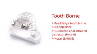 Tooth Borne
+Razdolsky’s tooth borne
ROD Appliance
+ Guerrero’s et al intraoral
distractor (Hybrid)
+ Hyrax (SARME)
 
