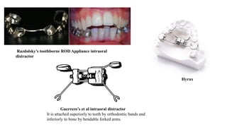 Razdolsky’s toothborne ROD Appliance intraoral
distractor
Hyrax
Guerrero’s et al intraoral distractor
It is attached superiorly to teeth by orthodontic bands and
inferiorly to bone by bendable forked arms.
 