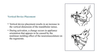 Vertical Device Placement
• Vertical device placement results in an increase in
the vertical dimension of the mandibular ramus.
• During activation, a change occurs in appliance
orientation that appears to be caused by the
nonlinear molding effect of the neuromusculature on
the regenerate.
 