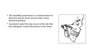 • The mandible autorotates in a counterclockwise
direction and the lower incisors take a more
advanced position.
• A posterior open bite may occur on the side that
has undergone vertical distraction in the ramus.
 