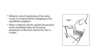 • Bilateral vertical lengthening of the ramus
results in counterclockwise uprighting of the
mandibular symphysis.
• When combined with the sagittal advancement
of the mandibular body, the increased
prominence of the lower third of the face is
evident.
 