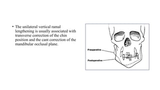 • The unilateral vertical ramal
lengthening is usually associated with
transverse correction of the chin
position and the cant correction of the
mandibular occlusal plane.
 