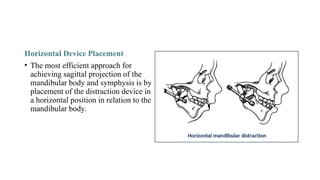 Horizontal Device Placement
• The most efficient approach for
achieving sagittal projection of the
mandibular body and symphysis is by
placement of the distraction device in
a horizontal position in relation to the
mandibular body.
 