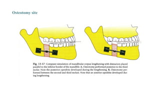 Osteotomy site
 