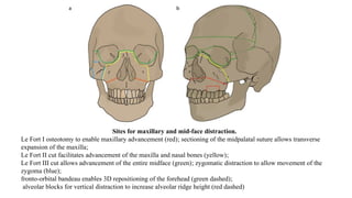 Sites for maxillary and mid-face distraction.
Le Fort I osteotomy to enable maxillary advancement (red); sectioning of the midpalatal suture allows transverse
expansion of the maxilla;
Le Fort II cut facilitates advancement of the maxilla and nasal bones (yellow);
Le Fort III cut allows advancement of the entire midface (green); zygomatic distraction to allow movement of the
zygoma (blue);
fronto-orbital bandeau enables 3D repositioning of the forehead (green dashed);
alveolar blocks for vertical distraction to increase alveolar ridge height (red dashed)
 
