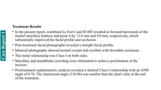 Treatment Results
• In the present report, combined Le Fort I and III DO resulted in forward movement of the
medial maxillary buttress and point A by 12.0 mm and 9.0 mm, respectively, which
substantially improved the facial profile and occlusion.
• Post-treatment facial photographs revealed a straight facial profile.
• Intraoral photographs showed normal overjet and overbite with favorable occlusion.
• The molar relationship was Class I on both sides.
• Maxillary and mandibular crowding were eliminated to achieve proclination of the
incisors.
• Posttreatment cephalometric analysis revealed a skeletal Class I relationship with an ANB
angle of 0.78. The interincisal angle (110.88) was smaller than the ideal value at the end
of the treatment.
Case
Report
1
 