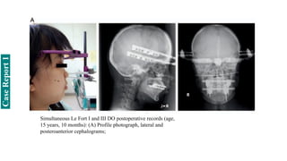Simultaneous Le Fort I and III DO postoperative records (age,
15 years, 10 months): (A) Profile photograph, lateral and
posteroanterior cephalograms;
Case
Report
1
 