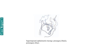 Superimposed cephalometric tracings: presurgery (black),
postsurgery (blue).
Case
Report
1
 