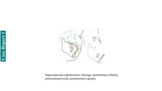 Superimposed cephalometric tracings: pretreatment (black),
posttreatment (red), postretention (green).
Case
Report
1
 