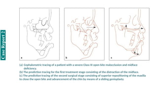 (a) Cephalometric tracing of a patient with a severe Class III open bite malocclusion and midface
deficiency.
(b) The prediction tracing for the first treatment stage consisting of the distraction of the midface.
(c) The prediction tracing of the second surgical stage consisting of superior repositioning of the maxilla
to close the open bite and advancement of the chin by means of a sliding genioplasty.
Case
Report
2
 