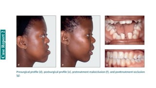 Case
Report
2
Presurgical profile (d), postsurgical profile (e), pretreatment malocclusion (f), and posttreatment occlusion
(g).
 