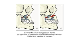 Example of maxillary DO hypoplastic maxilla.
(a) Application of internal distractor device following osteotomy.
(b) Distracted maxilla in AP direction.
 