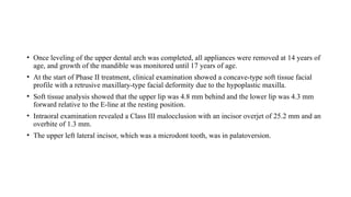 • Once leveling of the upper dental arch was completed, all appliances were removed at 14 years of
age, and growth of the mandible was monitored until 17 years of age.
• At the start of Phase II treatment, clinical examination showed a concave-type soft tissue facial
profile with a retrusive maxillary-type facial deformity due to the hypoplastic maxilla.
• Soft tissue analysis showed that the upper lip was 4.8 mm behind and the lower lip was 4.3 mm
forward relative to the E-line at the resting position.
• Intraoral examination revealed a Class III malocclusion with an incisor overjet of 25.2 mm and an
overbite of 1.3 mm.
• The upper left lateral incisor, which was a microdont tooth, was in palatoversion.
 