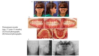Pretreatment records
(age, 17 years 11 months).
(A) Facial photographs.
(B) Intraoral photographs.
 