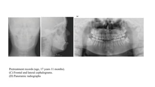 Pretreatment records (age, 17 years 11 months).
(C) Frontal and lateral cephalograms.
(D) Panoramic radiographs
 
