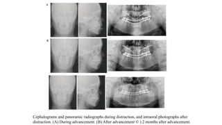 Cephalograms and panoramic radiographs during distraction, and intraoral photographs after
distraction. (A) During advancement. (B) After advancement © ) 2 months after advancement.
 