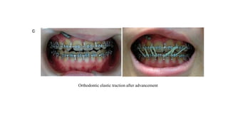 Orthodontic elastic traction after advancement
 