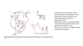 •The maxilla was advanced 5.4 mm
horizontally and was displaced 1.5 mm
downward at Point A relative to the
sella-nasion (SN) plane and its
perpendicular line.
•The upper incisors were tipped labially
2.0 mm anteriorly, and the molars were
moved to the mesial 1.4 mm.
•The lower incisors were slightly rotated
lingually and extruded.
 