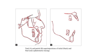 Total (A) and partial (B) superimpositions of initial (black) and
final (red) cephalometric tracings.
 