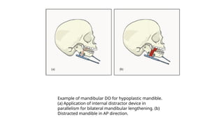 Example of mandibular DO for hypoplastic mandible.
(a) Application of internal distractor device in
parallelism for bilateral mandibular lengthening. (b)
Distracted mandible in AP direction.
 