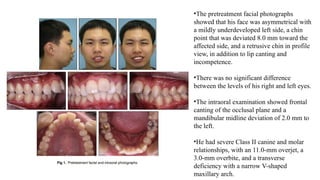 •The pretreatment facial photographs
showed that his face was asymmetrical with
a mildly underdeveloped left side, a chin
point that was deviated 8.0 mm toward the
affected side, and a retrusive chin in profile
view, in addition to lip canting and
incompetence.
•There was no significant difference
between the levels of his right and left eyes.
•The intraoral examination showed frontal
canting of the occlusal plane and a
mandibular midline deviation of 2.0 mm to
the left.
•He had severe Class II canine and molar
relationships, with an 11.0-mm overjet, a
3.0-mm overbite, and a transverse
deficiency with a narrow V-shaped
maxillary arch.
 