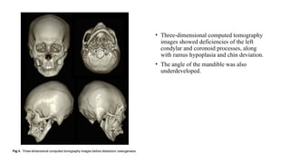 • Three-dimensional computed tomography
images showed deficiencies of the left
condylar and coronoid processes, along
with ramus hypoplasia and chin deviation.
• The angle of the mandible was also
underdeveloped.
 