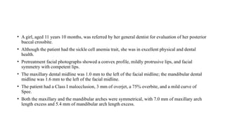 • A girl, aged 11 years 10 months, was referred by her general dentist for evaluation of her posterior
buccal crossbite.
• Although the patient had the sickle cell anemia trait, she was in excellent physical and dental
health.
• Pretreatment facial photographs showed a convex profile, mildly protrusive lips, and facial
symmetry with competent lips.
• The maxillary dental midline was 1.0 mm to the left of the facial midline; the mandibular dental
midline was 1.6 mm to the left of the facial midline.
• The patient had a Class I malocclusion, 3 mm of overjet, a 75% overbite, and a mild curve of
Spee.
• Both the maxillary and the mandibular arches were symmetrical, with 7.0 mm of maxillary arch
length excess and 5.4 mm of mandibular arch length excess.
 