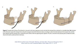 Sophy Barber Lachlan Carter, Christopher Mannion, and Claire Bates. Distraction Osteogenesis Part 1:
History and Uses in the Craniofacial Region. Ortho Update 2018; 11: 14–20
 