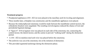 Treatment progress
• Preadjusted appliances (.018 .022 in) were placed in the maxillary arch for leveling and alignment.
• Three months later, a biteplate was constructed, and the mandibular appliances were placed.
• Because the midsymphyseal osteotomy would be made between the mandibular central incisors, the
orthodontic brackets were angulated. The resulting root divergence reduced the chance of root and
periodontal ligament damage.
• A “figure 8” .014-in ligature wire was placed on each side of the osteotomy site, connecting the
central incisor, the lateral incisor, and the canine to prevent “walking teeth” during the distraction
period.
• A .016 .022-in stainless-steel arch wire was placed before the osteotomy.
• The archwire was cut at the osteotomy site at the initiation of distraction.
• This provided segmental anchorage during the distraction phase.
 