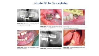 Alveolar DO for Crest widening
 