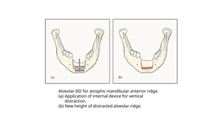 Alveolar DO for atrophic mandibular anterior ridge.
(a) Application of internal device for vertical
distraction.
(b) New height of distracted alveolar ridge.
 