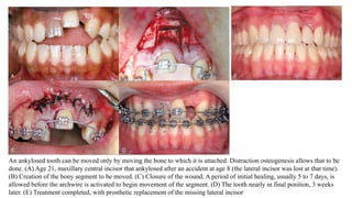 An ankylosed tooth can be moved only by moving the bone to which it is attached. Distraction osteogenesis allows that to be
done. (A) Age 21, maxillary central incisor that ankylosed after an accident at age 8 (the lateral incisor was lost at that time).
(B) Creation of the bony segment to be moved. (C) Closure of the wound. A period of initial healing, usually 5 to 7 days, is
allowed before the archwire is activated to begin movement of the segment. (D) The tooth nearly in final position, 3 weeks
later. (E) Treatment completed, with prosthetic replacement of the missing lateral incisor
 