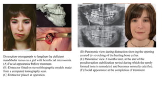 Distraction osteogenesis to lengthen the deficient
mandibular ramus in a girl with hemifacial microsomia.
(A) Facial appearance before treatment.
(B) Distractor fitted on stereolithographic models made
from a computed tomography scan.
(C) Distractor placed at operation.
(D) Panoramic view during distraction showing the opening
created by stretching of the healing bone callus.
(E) Panoramic view 3 months later, at the end of the
postdistraction stabilization period during which the newly
formed bone is remodeled and becomes normally calcified.
(F) Facial appearance at the completion of treatment
 
