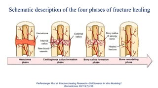 Pieffenberger M et al. Fracture Healing Research—Shift towards In Vitro Modeling?
Biomedicines 2021:9(7);748.
Schematic description of the four phases of fracture healing
 