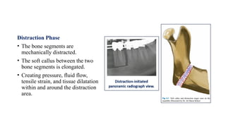 Distraction Phase
• The bone segments are
mechanically distracted.
• The soft callus between the two
bone segments is elongated.
• Creating pressure, fluid flow,
tensile strain, and tissue dilatation
within and around the distraction
area.
 