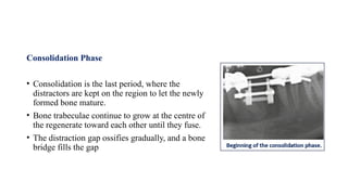 Consolidation Phase
• Consolidation is the last period, where the
distractors are kept on the region to let the newly
formed bone mature.
• Bone trabeculae continue to grow at the centre of
the regenerate toward each other until they fuse.
• The distraction gap ossifies gradually, and a bone
bridge fills the gap
 