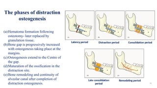 The phases of distraction
osteogenesis
(a)Hematoma formation following
osteotomy- later replaced by
granulation tissue.
(b)Bone gap is progressively increased
with osteogenesis taking place at the
margins.
(c)Osteogenesis extend to the Centre of
the gap.
(d)Maturation of the ossification in the
distraction site.
(e)Bone remodeling and continuity of
alveolar canal after completion of
distraction osteogenesis.
 