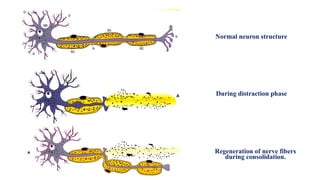 During distraction phase
Normal neuron structure
Regeneration of nerve fibers
during consolidation.
 