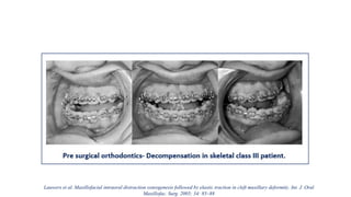 Lauwers et al. Maxillofacial intraoral distraction osteogenesis followed by elastic traction in cleft maxillary deformity. Int. J. Oral
Maxillofac. Surg. 2005; 34: 85–88
 