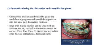 Orthodontics during the distraction and consolidation phase
• Orthodontic traction can be used to guide the
tooth-bearing regions and mould the regenerate
into the ideal post distraction position.
• Inter-arch elastic traction can be used with an
anteroposterior, vertical or transverse vector to
correct Class II or Class III discrepancies, reduce
open bites or correct cross bites and cants.
 