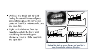 • Occlusal bite-block can be used
during the consolidation and post-
consolidation phase to supra-erupt
posterior dentition to correct the cant
and open bite.
• Light vertical elastics from the
maxillary arch to the lower arch
would help in controlling the
clockwise rotation of the mandible
and open bite.
 