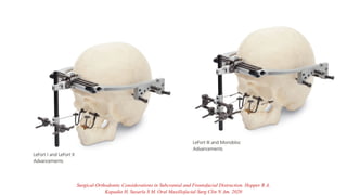 Surgical-Orthodontic Considerations in Subcranial and Frontofacial Distraction. Hopper R A,
Kapadia H, Susarla S M. Oral Maxillofacial Surg Clin N Am. 2020
 