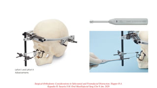 Surgical-Orthodontic Considerations in Subcranial and Frontofacial Distraction. Hopper R A,
Kapadia H, Susarla S M. Oral Maxillofacial Surg Clin N Am. 2020
 
