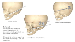 Indicated:
Correction of craniofacial
malformations such as
syndromic craniosynostosis and
congenital deficiencies
It is used for patients requiring
facial advancement (Le Fort III/
monobloc)
 