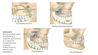 Indicated:
Where gradual bone
lengthening is
required, particularly
as a result of
congenital and
acquired
malformations,
deficits and
hypoplasia.
 
