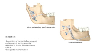 Indication:
•Correction of congenital or acquired
malformation and hypoplasia
•Reconstruction of the mandibular
ramus.
•Congenital malformation
 