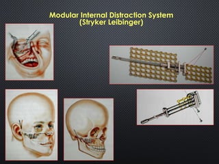 Injection Distraction Distraction Osteogenesis in Oral and Maxillofacial Surgery | PPTX